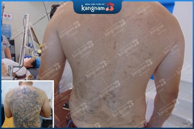 Xăm mảng lớn giảm đến 80% sau lần điều trị đầu tiên