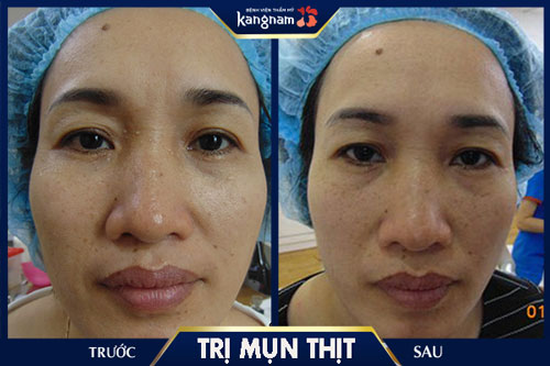 điều trị mụn thịt