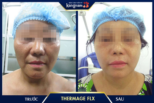 Hiệu quả nâng cơ, khắc phục nếp nhăn rãnh mũi, má lên đến 90% chỉ sau 1 lần điều trị xóa nếp nhăn cánh mũi