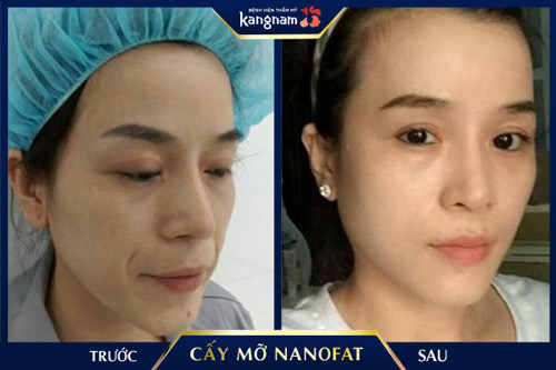 Vùng rãnh nhăn mũi má được cải thiện toàn bộ sau khi cấy mỡ Nano Fat, mang lại gương mặt tươi trẻ, làn da căng đầy nếp nhăn ở mũi