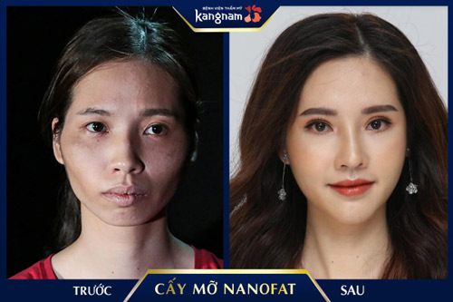 Cấy mỡ Nano Fat giúp làm đầy rãnh mũi má, cải thiện toàn bộ gương mặt già nua trẻ ra đến 10 tuổi xóa nếp nhăn rãnh mũi