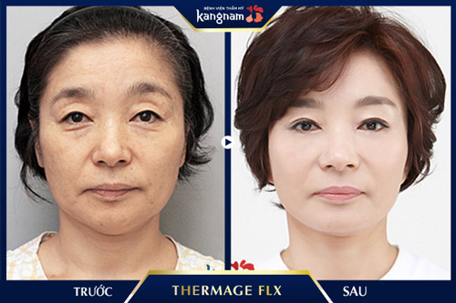 Công nghệ Thermage mang tới gương mặt tươi trẻ, rạng ngời cho khách hàng xóa nếp nhăn thermage