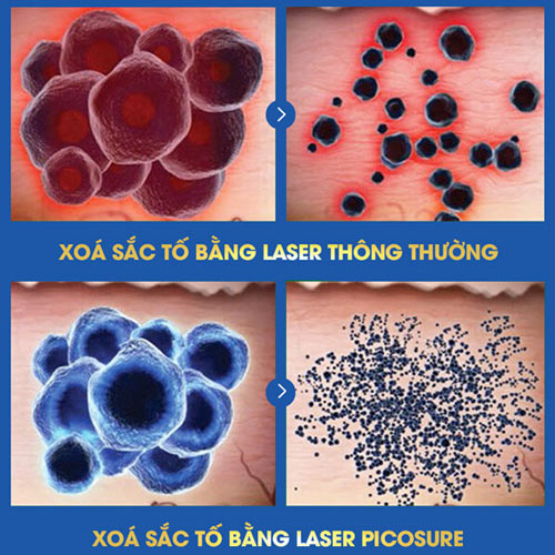 So sánh hiệu quả xóa viền môi xăm bằng Laser Picosure và thế hệ Laser thông thường xóa xăm môi bằng cách nào
