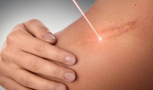 Ánh sáng đa sắc thông minh của ELLA có thể tác động chính xác vào mô sẹo để phá vỡ liên kết của chúng xóa sẹo lồi