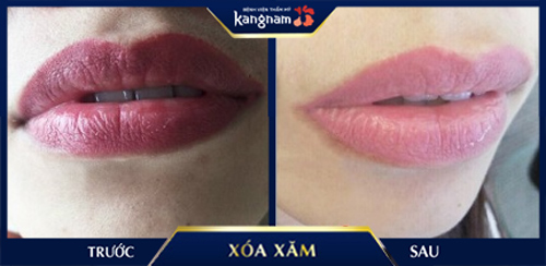 Hiệu quả xóa phun môi bằng Laser Picosure giúp loại bỏ hoàn toàn mọi sắc tố mực xăm xoá phun môi