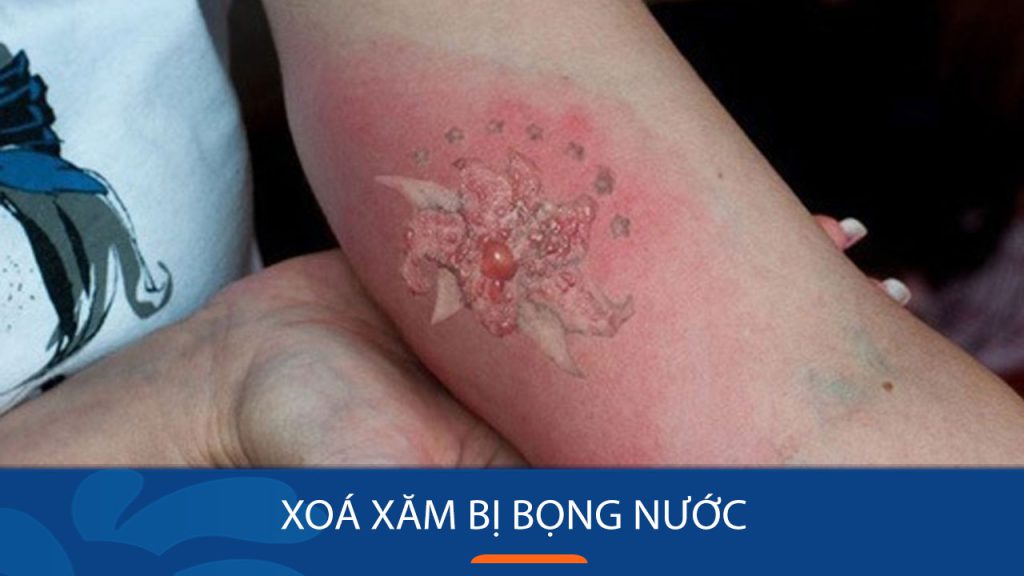 Xoá xăm bị bọng nước, sưng đỏ, nhiễm trùng: lưu ý để xóa xăm an toàn