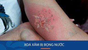 Xoá xăm bị bọng nước, sưng đỏ, nhiễm trùng: lưu ý để xóa xăm an toàn