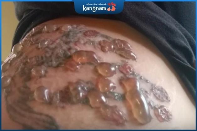 Bọng nước có thể là phản ứng bình thường của những làn da quá nhạy cảm