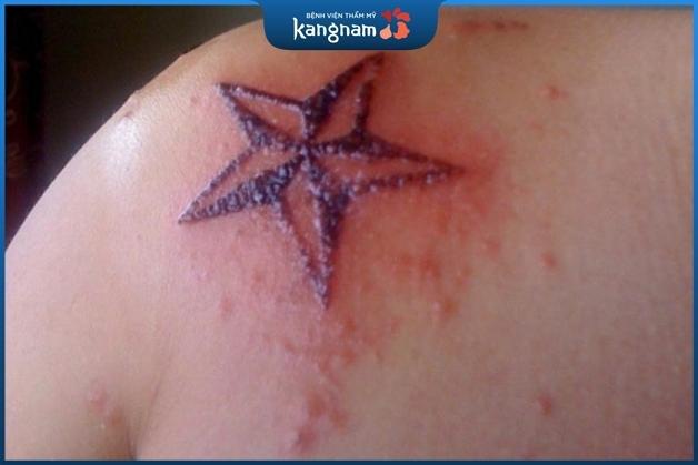 Sau khi xóa xăm, da thường sưng và hơi đỏ tại vùng điều trị