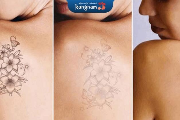 Xóa hình xăm giá rẻ gây bỏng da và để lại sẹo lồi kém thẩm mỹ