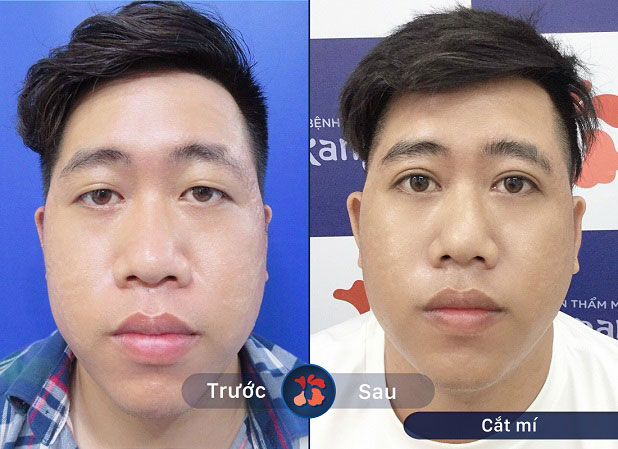 Rất nhiều khách hàng nam tin tưởng và lựa chọn nhấn mí mắt