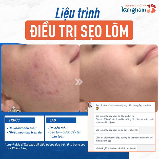 Phục hồi da phẳng mịn với công nghệ điều trị sẹo lõm cấy da vi điểm