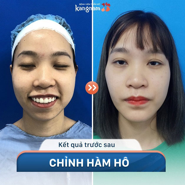 Hàm hô nặng, lệch khớp cắn, gò má cao, khuôn mặt lệch, không cân xứng