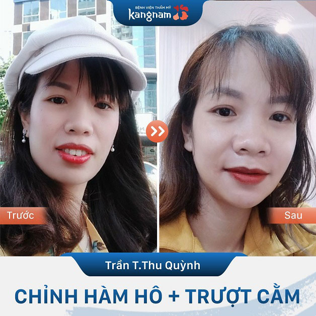 Phẫu thuật trượt cằm, xương và răng bị tiêu biến do kháng sinh liều cao, lệch khớp cắt