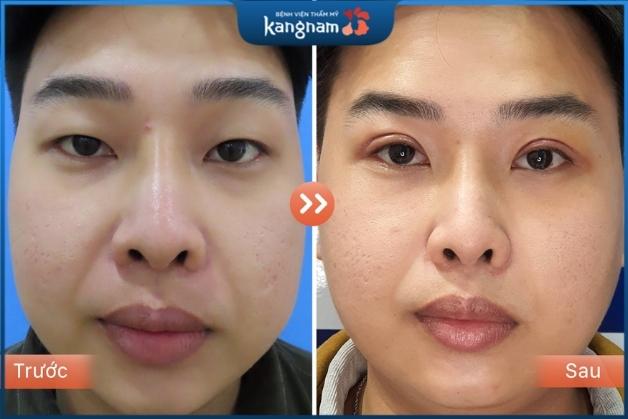 Khách hàng nhấn mí nam tại Kangnam Hà Nội