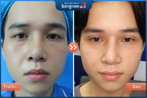 Nhấn mí nam Hà Nội an toàn