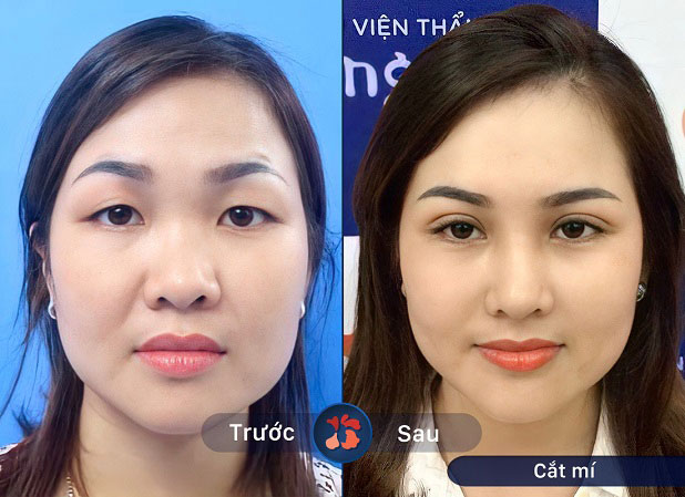 Cắt mí sau 20 ngày 