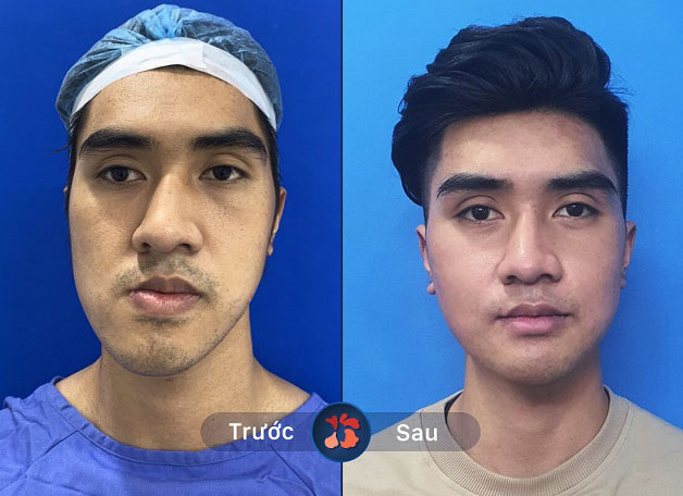 Khách hàng nam phẫu thuật hàm móm thành công tại Kangnam