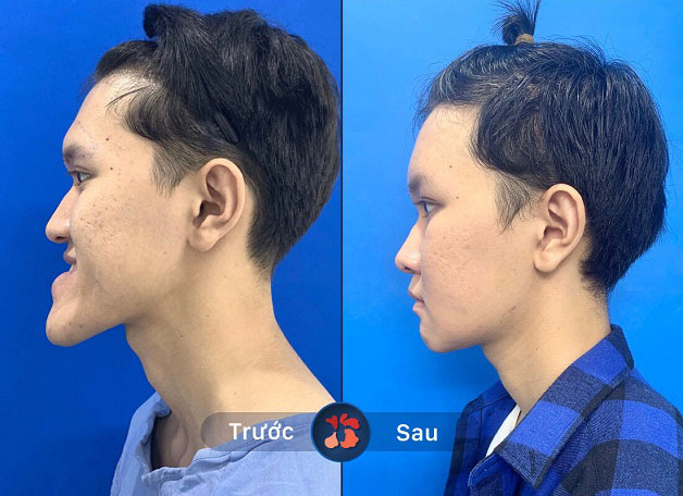 Hàm móm nặng, trượt hàm dưới và gần như không thể cười