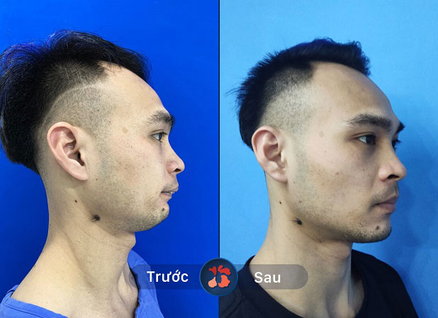 Anh Hoàng chỉnh hàm hô và cằm lẹm tại Kangnam