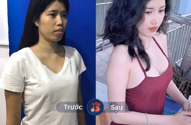 Kết quả nâng ngực được 1 tuần