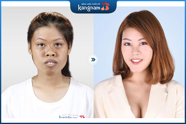 Khuôn mặt hài hòa hơn sau khi điều chỉnh hàm hô