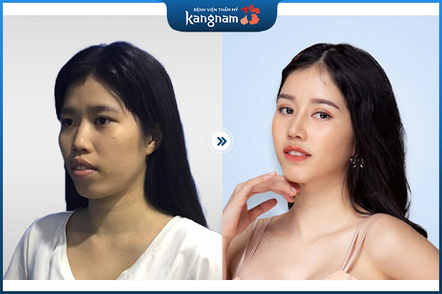 Khuôn mặt hài hòa hơn sau khi phẫu thuật chỉnh hình hàm hô