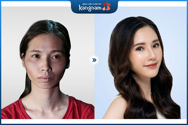 Phan Thị May chỉnh hàm hô xong đem lại khuôn mặt hoàn hảo chuẩn tỷ lệ vàng