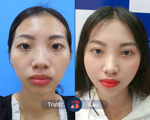 Trước và sau khi khách hàng nhấn mí tại Kangnam