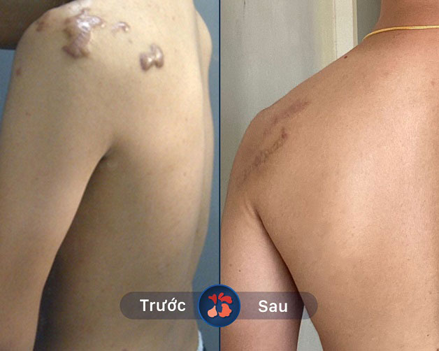 Khắc phục sẹo lồi trên vai