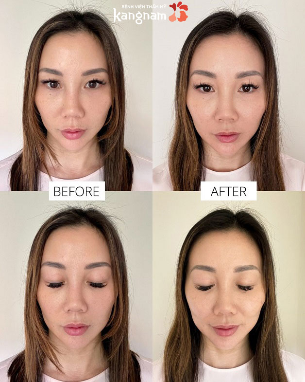 Khắc phục mọi nếp nhăn trên da mặt của khách hàng