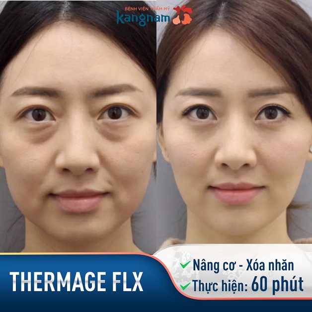 Gương mặt có phần lão hóa, chảy xệ đã được khắc phục toàn bộ, kéo lại đến 10 năm tuổi xuân chỉ với 1 lần thực hiện duy nhất