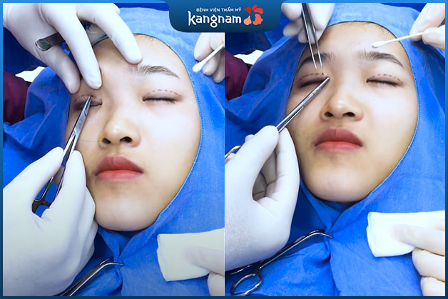 Bấm mí được thực hiện bởi đội ngũ bác sĩ có chuyên môn cao.