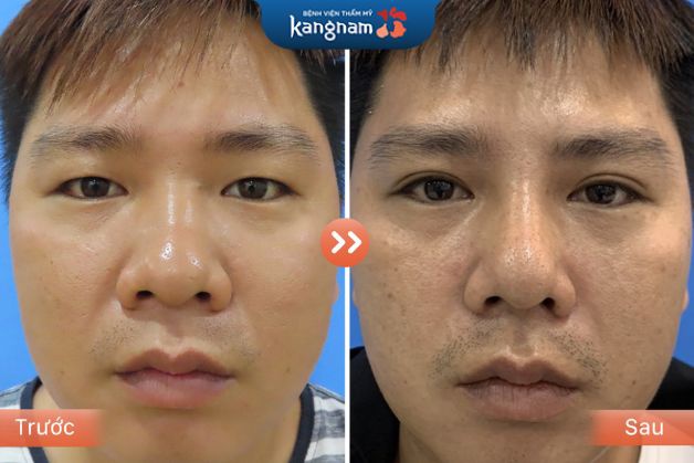 Trước và sau khi khách hàng cắt mí