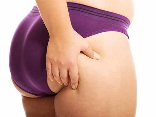 Có nhiều nguyên nhân khiến mỡ tích tụ tại mông giảm mỡ mông