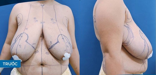 ăn gì để ngực nhỏ lại