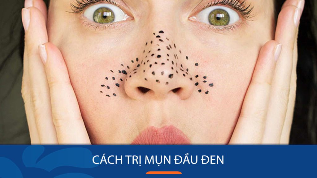Vì sao da bạn luôn xuất hiện mụn đầu đen? Bí quyết loại bỏ tận gốc chỉ trong 7 ngày