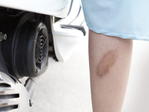 cách trị sẹo bỏng bô lâu năm