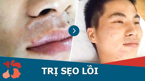 BVTM Kangnam có riêng chuyên khoa da liễu chữa sẹo lồi uy tín, chất lượng cao cách trị sẹo lồi ở mũi