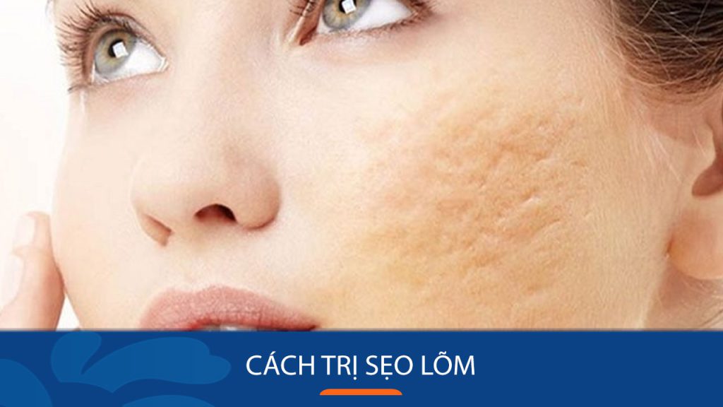 6 Cách trị sẹo lõm sau khi tẩy nốt ruồi hiệu quả không tốn kém