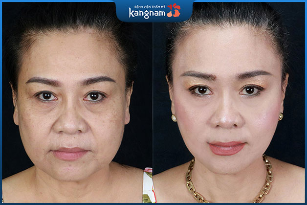 Trẻ hoá an toàn tại Kangnam