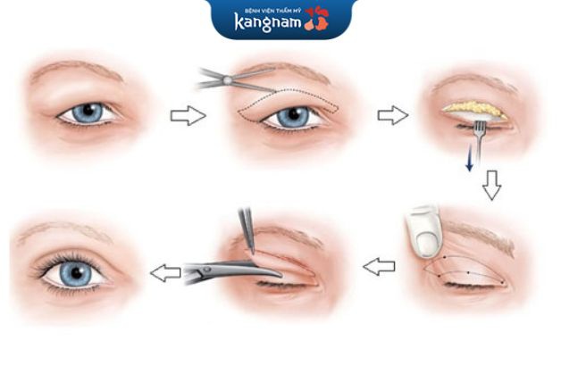 Cắt mí mắt nam giới được thực hiện như thế nào?