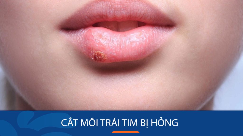 Cắt môi trái tim bị hỏng: Giải pháp khắc phục và chăm sóc