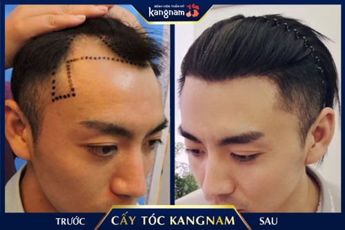 nên cấy tóc ở đâu