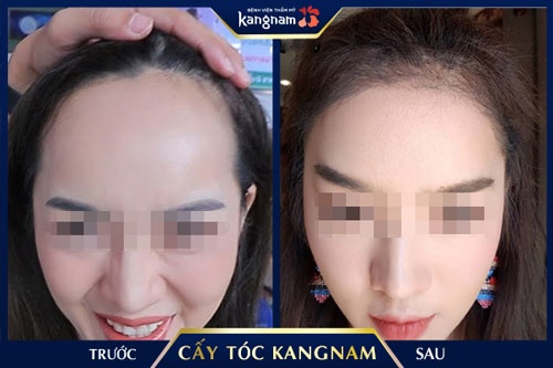 Kangnam - địa chỉ cấy tóc và lông mày uy tín tại Hà Nội và TP.HCM cấy lông mày ở đâu