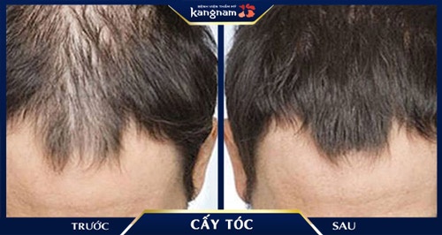 Hình ảnh thay đổi 180 độ vùng da đầu hói sau khi thực hiện điều trị rụng tóc tại Kangnam cấy tóc tự thân