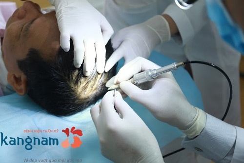 tác hại của cấy tóc