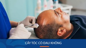 Cấy tóc có đau không? Những lưu ý từ chuyên gia