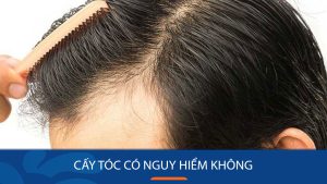 Cấy tóc có nguy hiểm không? Cảnh báo từ chuyên gia thẩm mỹ