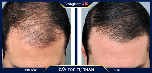 Khách hàng Thuận 60 tuổi đã sở hữu mái đầu hết hói, tóc dày rậm giúp anh trẻ ra đến 10 tuổi sau khi sử dụng dịch vụ tại Kangnam cấy tóc là gì